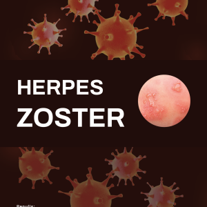HERPES ZOSTER